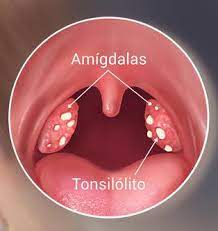 informacion sobre el tratamiento del caseum o tonsilolitos tonsilolitos enjuague bucal casero cosas de enfermeria