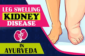 How Can Leg Swelling Significant Sign Of Kidney Problems Be Cured Swollen Legs Swellings Kidney Problems Signs