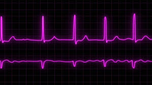 Image result for Extrasystole