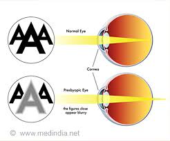Presbyopia Causes Symptoms Diagnosis Treatment Prevention