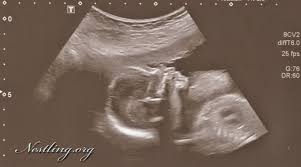 Schwangerschaftswoche (kurz ssw) haben sie die hälfte ihrer schwangerschaft erreicht. Baby Update 20 Ssw 19 3 Ii Screening Babyartikel De Magazin