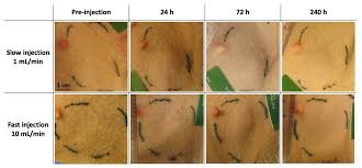 Image result for Subcutaneous Injection