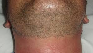 London laser clinic number1 laser clinic. Laser Hair Removal Treatments Surrey South London Light Fantastic Ipl