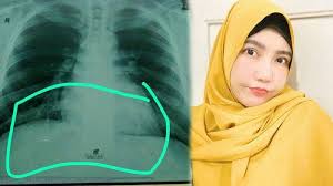 Bagikan Foto Rontgen Paru Paru Via Vallen Cerita Adiknya Positif Corona Awalnya Enggan Test Swab Tribunnewsmaker Com