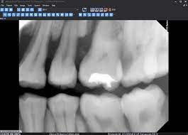 Mach Effect Correction Medicor Imaging
