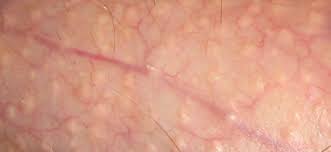 Pimples on penile shaft from molluscum contagiosum. Pimple Like Bumps On Penis And Testicles Men S Health Articles Family Health Center Steadyhealth Com