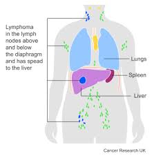 Image result for Lymphoma