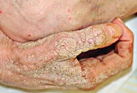 Image result for scabies norvegica