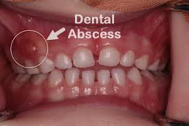 Image result for Periodontal Abscess