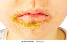 Image result for yellow scabs on the face in children