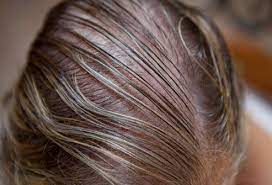 Women S Hair Loss Thinning Hair Causes And Solutions Hairstyles For Thin Hair Hair Loss Remedies Thin Hair Styles For Women