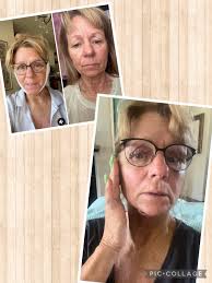 Creating faces from lips after skin surgery experience