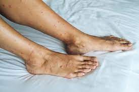 Apa tidaknya, kegatalan akibat gigitan pepijat ini boleh menyebabkan kulit lecur bagi yang kulitnya sensitif. Kesan Gigitan Pepijat Pada Badan Anda Bagaimana Nak Elak