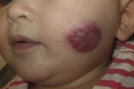 Those bright red spots on your skin are known as cherry angiomas. Infantile And Congenital Hemangiomas Sciencedirect