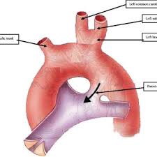 Pdf Co Existence Of Patent Ductus Arteriosus And Left Brachiocephalic Artery A Case Report The brachiocephalic trunk from behind the vessel and the right carotid artery along with the right.