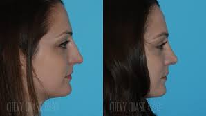 We did not find results for: Rhinoplasty Before After Photos Chevy Chase Facial Plastic Surgery