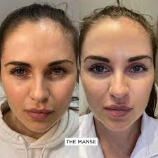Especially often celebrities inject the botex into the nasolabial triangle, into the area between the. Eyebrow Lifting Best Clinic Sydney For Dermal Fillers