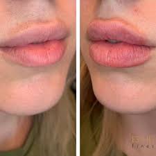 As lip fillers are a relatively quick treatment with little downtime needed, it can be tempting to carry on with your normal activities straight away. Esthetic Finesse Flawless Lip Injections Scottsdale