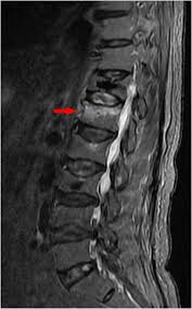 Image result for Vertebral Compression Fracture