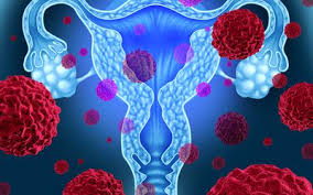 Image result for endometrial cancer diagnosis