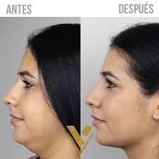 ✨LIPO PAPADA✨ ¡Di adiós a la papada y dale la bienvenida a una mandíbula  definida y elegante con nuestra asombrosa liposucción de papada! 😲✨ Es un  procedimiento seguro y efectivo que eliminará