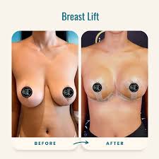 Breast Lift