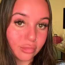 I looked like a tomato for a week and felt like my face was going to  explode