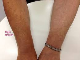 Plaquenil Pigmentation Pigment Skin Cushing Disease