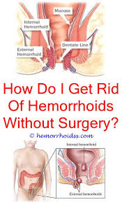 Hemorrhoids Where Do External Hemorrhoids Occur How Long Does It Take To Treat Hemorr Bleeding Hemorrhoids Hemorrhoids Treatment Getting Rid Of Hemorrhoids