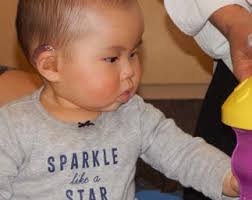 Pediatric Cochlear Implant Program