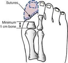 Image result for toe amputation