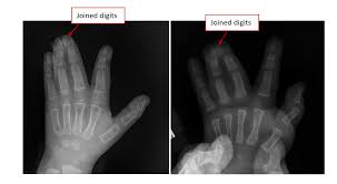 Image result for Syndactyly