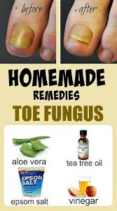 Home Remedies For Toe Fungus Toe Fungus Toenail Fungus Remedies Remedies