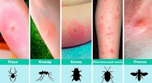 как снять отек от укуса осы в домашних условиях Mariupolskij Medichnij Koledzh Vnimanie Ukusy Nasekomyh 12 Vidov I Chto Delat Pri Kazhdom Iz Nih