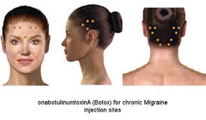 I've signed the paper saying yes you can use my pictures. What Are The Treatment Options For Migraine