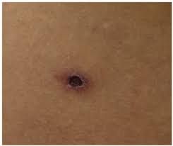 This condition can be related to burn injuries, spider bites, and gangrene. Eschar In Right Side Of The Waist Open I