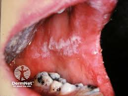 Image result for Oral thrush roof of mouth