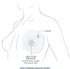 Image result for Mastectomy