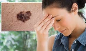 Itchy skin could be a sign of skin cancer if it is accompanied by: Skin Cancer Symptoms Shortness Of Breath Headaches Vision Changes Signs It S Spread Express Co Uk