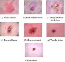 Vulvar amelanotic melanoma is an erythematous lesion without the typical characteristics of melanoma which may imitate a pyogenic granuloma 70. Skin Lesions Classification Using Deep Learning Based On Dilated Convolution Biorxiv