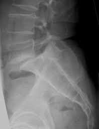 Spondylolisthesis Wikipedia