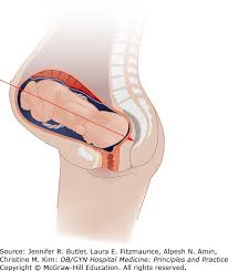 Image result for Manual Rotation in Occipitoposterior Presentation
