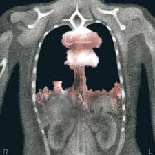 Ulcers do not always cause symptoms. How Much Do Ct Scans Increase The Risk Of Cancer Scientific American