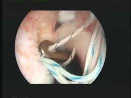 Rotator Cuff Repair Without Completing A Partial Tear Partial Articular Sided Tendon Avulsion Youtube