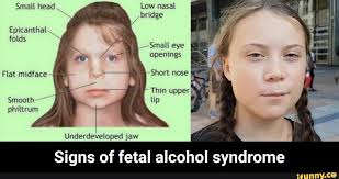 Increased space between 1st and 2nd toes; Low Nasal Bridge Small Head Flat Mldface Short Nose Thm Upper Smooth Hp Signs Of Fetal Alcohol Syndrome Ifunny