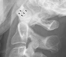 We did not find results for: Atlanto Axial Joint Wikipedia