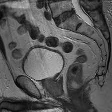 Adenocarcinoma cancers being usually in one of the following organs: Radiology Quiz 16674 Radiopaedia Orgviewing Playlist 4c 023 Staging Prostate Cancer Radiopaedia Org