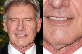 6 Famous Celebrities And Their Scars Honolulu Dermatologist 6 famous celebrities and their scars
