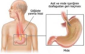 Reflu Nedir Reflu Belirtileri Ve Tedavi Reflu Saglik Karin Agrisi