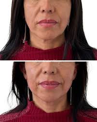 Resultado inmediato de Ellansé : un bioestimulador a base de  policaprolactona. El objetivo de los bioestimuladores es inducir la  producción de nuevo colágeno y elastina, y recuerden que se demoran 3 meses